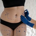 Body Hair and Hair Loss Concerns for Liposuction Patients