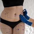 The Benefits of Liposuction: Removing Excess Fat and Improving Your Body