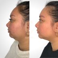 Double Chin Liposuction: A Guide to Achieving a Defined Jawline