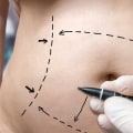 Understanding the Average Cost of Different Types of Liposuction