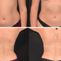 All About Female Liposuction Before and After Photos