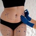 The Fascinating History of Liposuction