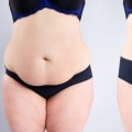 Pregnancy and Postpartum Liposuction Considerations: What You Need to Know