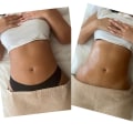 Realistic expectations for non-surgical liposuction results