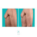 Exploring Before and After Photos of Male Liposuction Patients