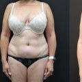 What to Expect After Liposuction: Your Guide to Recovery