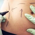 Understanding Surgical Techniques for Liposuction