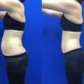 The Power of Patient Stories and Testimonials in Liposuction for Women