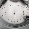 Exploring Non-Surgical Options for Liposuction