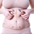 Factors that Affect the Cost of Liposuction: Understanding the Procedure and Alternatives