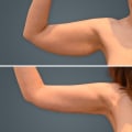 Arm and Back Liposuction for Improved Contouring: Everything You Need to Know