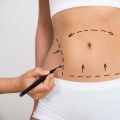 Tips for a Successful Recovery from Liposuction