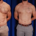 Realistic Expectations for Male Liposuction Results