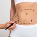 Realistic Expectations for Female Liposuction Results: What You Need to Know