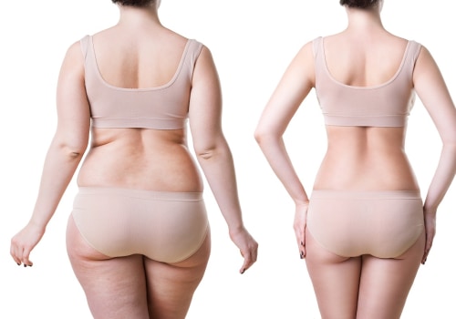 Exploring the Potential Impact of Liposuction on Breast Size and Shape