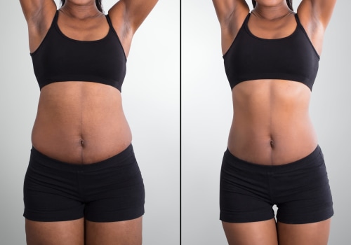 Understanding Non-Surgical Liposuction: Before and After Photos