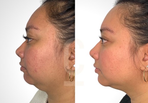 Double Chin Liposuction: A Guide to Achieving a Defined Jawline