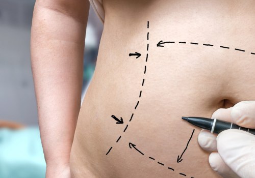 Understanding the Average Cost of Different Types of Liposuction