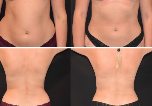 All About Female Liposuction Before and After Photos