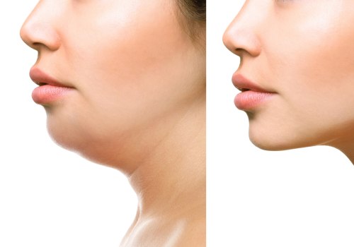 A Comprehensive Look at Injection Lipolysis (Kybella)