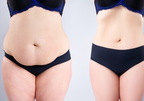 Pregnancy and Postpartum Liposuction Considerations: What You Need to Know