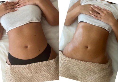 Realistic expectations for non-surgical liposuction results