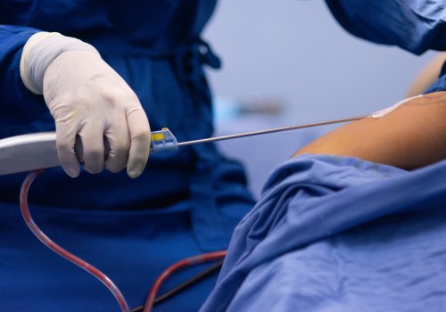 Understanding Different Types of Anesthesia for Liposuction