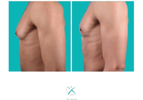 Exploring Before and After Photos of Male Liposuction Patients