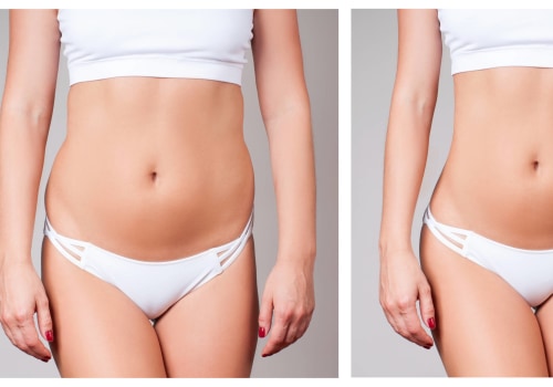 Explaining Non-Surgical Liposuction: Everything You Need to Know