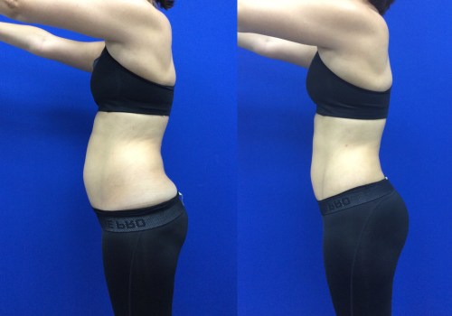 The Power of Patient Stories and Testimonials in Liposuction for Women