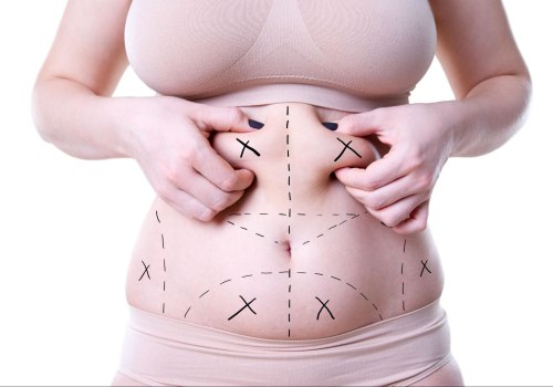 Factors that Affect the Cost of Liposuction: Understanding the Procedure and Alternatives