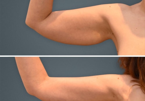 Arm and Back Liposuction for Improved Contouring: Everything You Need to Know