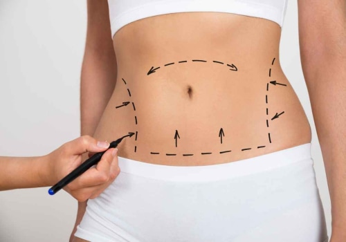 Tips for a Successful Recovery from Liposuction