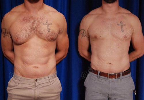 Realistic Expectations for Male Liposuction Results