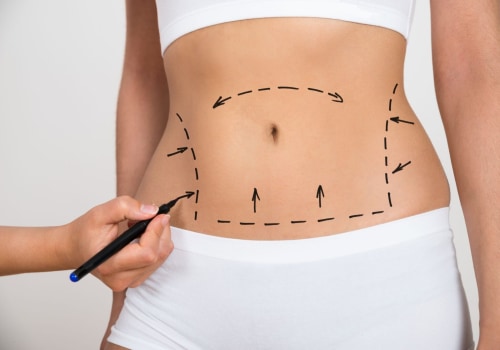 Realistic Expectations for Female Liposuction Results: What You Need to Know